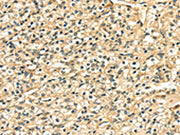 The image on the left is immunohistochemistry of paraffin-embedded Human prostate cancer tissue using CSB-PA444621(LAMA4 Antibody) at dilution 1/20, on the right is treated with fusion protein. (Original magnification: ×200)