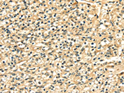 The image on the left is immunohistochemistry of paraffin-embedded Human prostate cancer tissue using CSB-PA444621(LAMA4 Antibody) at dilution 1/20, on the right is treated with fusion protein. (Original magnification: ×200)
