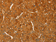 The image on the left is immunohistochemistry of paraffin-embedded Human liver cancer tissue using CSB-PA444635(RPL26L1 Antibody) at dilution 1/20, on the right is treated with fusion protein. (Original magnification: ×200)