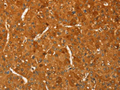 The image on the left is immunohistochemistry of paraffin-embedded Human liver cancer tissue using CSB-PA444635(RPL26L1 Antibody) at dilution 1/20, on the right is treated with fusion protein. (Original magnification: ×200)