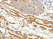 The image on the left is immunohistochemistry of paraffin-embedded Human liver cancer tissue using CSB-PA444792(PTHLH Antibody) at dilution 1/20, on the right is treated with fusion protein. (Original magnification: ×200)