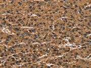 The image on the left is immunohistochemistry of paraffin-embedded Human liver cancer tissue using CSB-PA444799(ATP7A Antibody) at dilution 1/50, on the right is treated with synthetic peptide. (Original magnification: ×200)