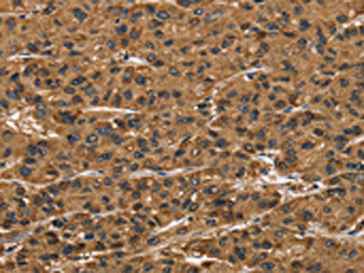 The image on the left is immunohistochemistry of paraffin-embedded Human liver cancer tissue using CSB-PA444799(ATP7A Antibody) at dilution 1/50, on the right is treated with synthetic peptide. (Original magnification: ×200)