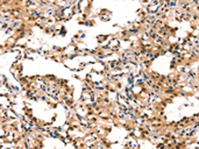 The image on the left is immunohistochemistry of paraffin-embedded Human thyroid cancer tissue using CSB-PA444901(CUL4B Antibody) at dilution 1/50, on the right is treated with synthetic peptide. (Original magnification: ×200)