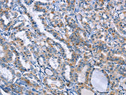 The image on the left is immunohistochemistry of paraffin-embedded Human thyroid cancer tissue using CSB-PA444926(LRRK2 Antibody) at dilution 1/20, on the right is treated with fusion protein. (Original magnification: ×200)