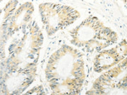 The image on the left is immunohistochemistry of paraffin-embedded Human colon cancer tissue using CSB-PA445195(TRAF1 Antibody) at dilution 1/20, on the right is treated with fusion protein. (Original magnification: ×200)