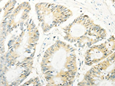 The image on the left is immunohistochemistry of paraffin-embedded Human colon cancer tissue using CSB-PA445195(TRAF1 Antibody) at dilution 1/20, on the right is treated with fusion protein. (Original magnification: ×200)