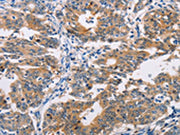 The image on the left is immunohistochemistry of paraffin-embedded Human gastic cancer tissue using CSB-PA445497(AGPAT4 Antibody) at dilution 1/25, on the right is treated with fusion protein. (Original magnification: ×200)