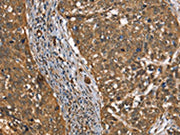 The image on the left is immunohistochemistry of paraffin-embedded Human cervical cancer tissue using CSB-PA445499(CSTB Antibody) at dilution 1/30, on the right is treated with synthetic peptide. (Original magnification: ×200)