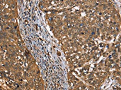 The image on the left is immunohistochemistry of paraffin-embedded Human cervical cancer tissue using CSB-PA445499(CSTB Antibody) at dilution 1/30, on the right is treated with synthetic peptide. (Original magnification: ×200)