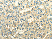 The image on the left is immunohistochemistry of paraffin-embedded Human liver cancer tissue using CSB-PA445587(DLAT Antibody) at dilution 1/30, on the right is treated with fusion protein. (Original magnification: ×200)