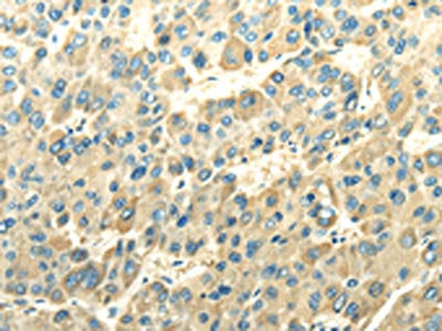 The image on the left is immunohistochemistry of paraffin-embedded Human liver cancer tissue using CSB-PA445587(DLAT Antibody) at dilution 1/30, on the right is treated with fusion protein. (Original magnification: ×200)
