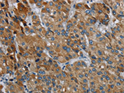 The image on the left is immunohistochemistry of paraffin-embedded Human liver cancer tissue using CSB-PA445627(PDSS2 Antibody) at dilution 1/30, on the right is treated with synthetic peptide. (Original magnification: ×200)