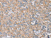 The image on the left is immunohistochemistry of paraffin-embedded Human liver cancer tissue using CSB-PA445651(S100A9 Antibody) at dilution 1/30, on the right is treated with synthetic peptide. (Original magnification: ×200)