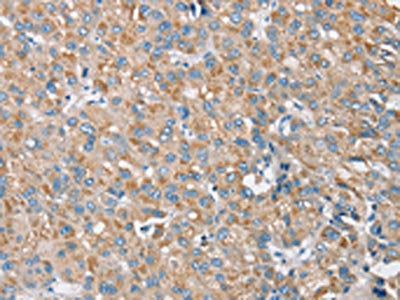The image on the left is immunohistochemistry of paraffin-embedded Human liver cancer tissue using CSB-PA445651(S100A9 Antibody) at dilution 1/30, on the right is treated with synthetic peptide. (Original magnification: ×200)