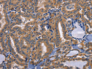 The image on the left is immunohistochemistry of paraffin-embedded Human thyroid cancer tissue using CSB-PA445679(CD47 Antibody) at dilution 1/50, on the right is treated with synthetic peptide. (Original magnification: ×200)