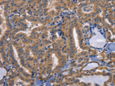 The image on the left is immunohistochemistry of paraffin-embedded Human thyroid cancer tissue using CSB-PA445679(CD47 Antibody) at dilution 1/50, on the right is treated with synthetic peptide. (Original magnification: ×200)