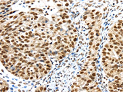 The image on the left is immunohistochemistry of paraffin-embedded Human breast cancer tissue using CSB-PA445680(TRIM33 Antibody) at dilution 1/40, on the right is treated with synthetic peptide. (Original magnification: ×200)