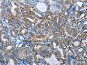 The image on the left is immunohistochemistry of paraffin-embedded Human thyroid cancer tissue using CSB-PA445711(AGL Antibody) at dilution 1/30, on the right is treated with synthetic peptide. (Original magnification: ×200)