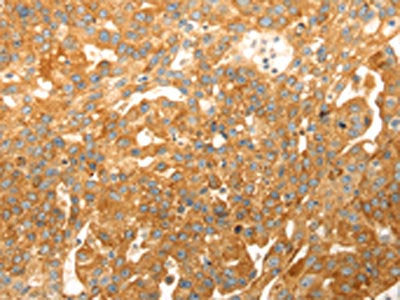 The image on the left is immunohistochemistry of paraffin-embedded Human breast cancer tissue using CSB-PA445743(CAPN1 Antibody) at dilution 1/20, on the right is treated with fusion protein. (Original magnification: ×200)