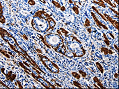 The image is immunohistochemistry of paraffin-embedded Human stomach cancer tissue using CSB-PA445794(ACE2 Antibody) at dilution 1/40. (Original magnification: ×200)