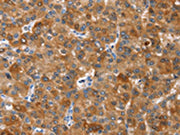 The image on the left is immunohistochemistry of paraffin-embedded Human liver cancer tissue using CSB-PA446192(NOD2 Antibody) at dilution 1/40, on the right is treated with synthetic peptide. (Original magnification: ×200)