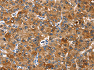 The image on the left is immunohistochemistry of paraffin-embedded Human liver cancer tissue using CSB-PA446192(NOD2 Antibody) at dilution 1/40, on the right is treated with synthetic peptide. (Original magnification: ×200)