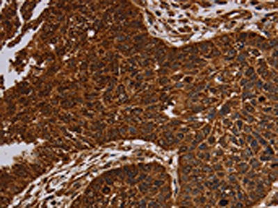 The image on the left is immunohistochemistry of paraffin-embedded Human lung cancer tissue using CSB-PA446344(NDUFAB1 Antibody) at dilution 1/50, on the right is treated with synthetic peptide. (Original magnification: ×200)