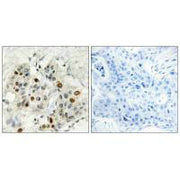 Immunohistochemistry analysis of paraffin-embedded human breast carcinoma tissue, using AF4 antibody.