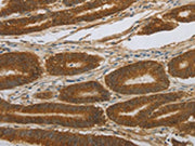 The image on the left is immunohistochemistry of paraffin-embedded Human colon cancer tissue using CSB-PA446675(NOTCH4 Antibody) at dilution 1/30, on the right is treated with synthetic peptide. (Original magnification: ×200)