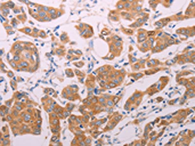 The image on the left is immunohistochemistry of paraffin-embedded Human breast cancer tissue using CSB-PA446811(AGT Antibody) at dilution 1/30, on the right is treated with synthetic peptide. (Original magnification: ×200)
