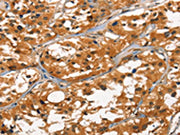 The image on the left is immunohistochemistry of paraffin-embedded Human thyroid cancer tissue using CSB-PA446983(DEFA1/3 Antibody) at dilution 1/30, on the right is treated with synthetic peptide. (Original magnification: ×200)