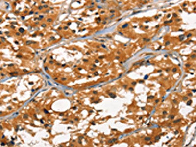 The image on the left is immunohistochemistry of paraffin-embedded Human thyroid cancer tissue using CSB-PA446983(DEFA1/3 Antibody) at dilution 1/30, on the right is treated with synthetic peptide. (Original magnification: ×200)