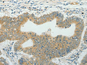 The image on the left is immunohistochemistry of paraffin-embedded Human colon cancer tissue using CSB-PA446984(CCND1 Antibody) at dilution 1/50, on the right is treated with fusion protein. (Original magnification: ×200)