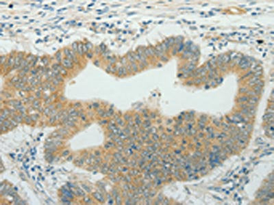 The image on the left is immunohistochemistry of paraffin-embedded Human colon cancer tissue using CSB-PA446984(CCND1 Antibody) at dilution 1/50, on the right is treated with fusion protein. (Original magnification: ×200)