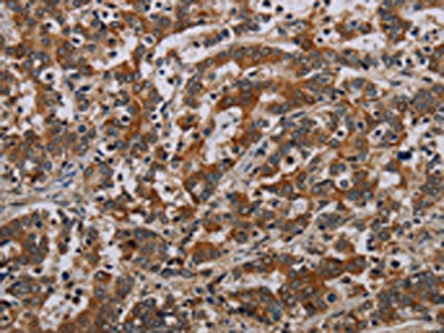 The image on the left is immunohistochemistry of paraffin-embedded Human liver cancer tissue using CSB-PA447017(NLRP9 Antibody) at dilution 1/40, on the right is treated with synthetic peptide. (Original magnification: ×200)