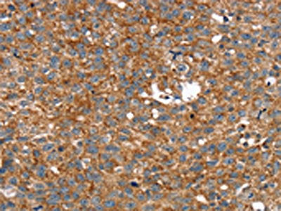The image on the left is immunohistochemistry of paraffin-embedded Human breast cancer tissue using CSB-PA447195(ARMC10 Antibody) at dilution 1/30, on the right is treated with fusion protein. (Original magnification: ×200)