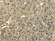 The image on the left is immunohistochemistry of paraffin-embedded Human breast cancer tissue using CSB-PA447196(TFDP2 Antibody) at dilution 1/25, on the right is treated with fusion protein. (Original magnification: ×200)