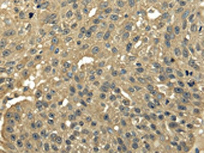 The image on the left is immunohistochemistry of paraffin-embedded Human breast cancer tissue using CSB-PA447196(TFDP2 Antibody) at dilution 1/25, on the right is treated with fusion protein. (Original magnification: ×200)