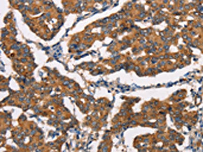 The image on the left is immunohistochemistry of paraffin-embedded Human breast cancer tissue using CSB-PA447308(DICER1 Antibody) at dilution 1/25, on the right is treated with synthetic peptide. (Original magnification: ×200)