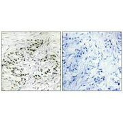 Immunohistochemistry analysis of paraffin-embedded human breast carcinoma tissue, using ERF antibody.