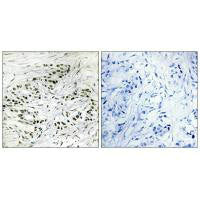 Immunohistochemistry analysis of paraffin-embedded human breast carcinoma tissue, using ERF antibody.