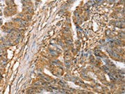 The image on the left is immunohistochemistry of paraffin-embedded Human esophagus cancer tissue using CSB-PA447564(SLC41A2 Antibody) at dilution 1/45, on the right is treated with synthetic peptide. (Original magnification: ×200)
