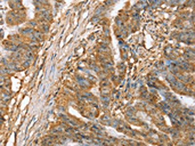 The image on the left is immunohistochemistry of paraffin-embedded Human esophagus cancer tissue using CSB-PA447564(SLC41A2 Antibody) at dilution 1/45, on the right is treated with synthetic peptide. (Original magnification: ×200)
