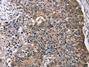 The image on the left is immunohistochemistry of paraffin-embedded Human esophagus cancer tissue using CSB-PA447601(RASSF7 Antibody) at dilution 1/45, on the right is treated with fusion protein. (Original magnification: ×200)