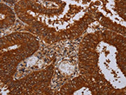 The image on the left is immunohistochemistry of paraffin-embedded Human colon cancer tissue using CSB-PA447621(MFAP3L Antibody) at dilution 1/50, on the right is treated with fusion protein. (Original magnification: ×200)