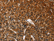 The image on the left is immunohistochemistry of paraffin-embedded Human liver cancer tissue using CSB-PA447681(CATSPER4 Antibody) at dilution 1/50, on the right is treated with fusion protein. (Original magnification: ×200)