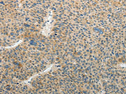 The image on the left is immunohistochemistry of paraffin-embedded Human liver cancer tissue using CSB-PA447714(TFPI2 Antibody) at dilution 1/25, on the right is treated with fusion protein. (Original magnification: ×200)