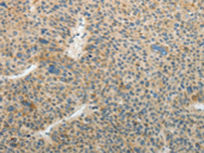 The image on the left is immunohistochemistry of paraffin-embedded Human liver cancer tissue using CSB-PA447714(TFPI2 Antibody) at dilution 1/25, on the right is treated with fusion protein. (Original magnification: ×200)