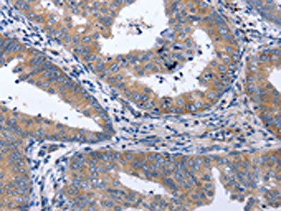 The image on the left is immunohistochemistry of paraffin-embedded Human cervical cancer tissue using CSB-PA447744(NPPB Antibody) at dilution 1/40, on the right is treated with synthetic peptide. (Original magnification: ×200)